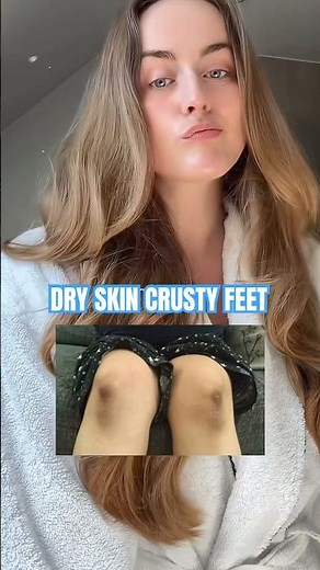 10% if you have dryness 40% if you need a little xtra help with cracked feet or hard skin ✅ #urea