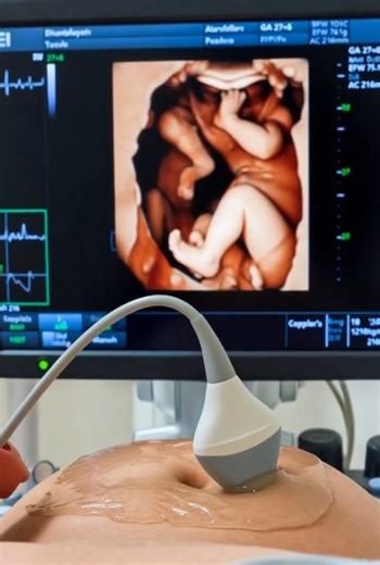 🔬 Triplet Monitoring: Advanced Doppler Vision #Shorts #Viral #Triplets #Triplettes #Ultrasound4D