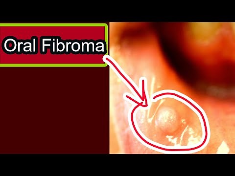 Oral Fibroma: Symptoms, causes, treatment