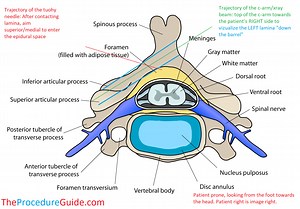 Fluoroscopic Guided Contralateral Oblique Cervical Interlaminar Epidural Steroid Injection - Technique and Overview - The Procedure Guide