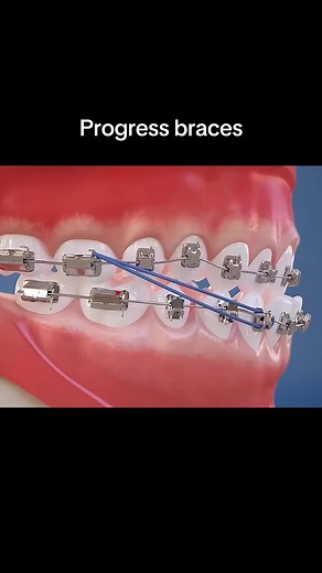 Achieve Orthodontic Progress with Braces for Your Teeth