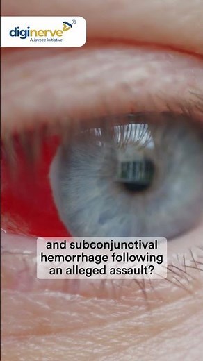 Identify patient’s condition presenting with orbital ecchymosis & subconjunctival hemorrhage.