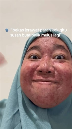 ceu kokom on Instagram: "Kind Watery Moisturizer dari Skin Game @skingameofficial pelembab ini cocok buat kulit berminyak seperti aku. Cobain deh~ #skingame #skingamemoisturizer #acnefighter #acnestory #acneproneskin"