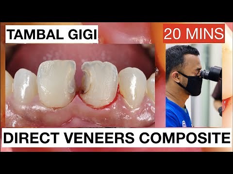 Step by Step Direct Veneers Composite Anterior Multiple Cases 20mins | General Dentist Griya RR