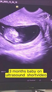 3 Months Baby Ultrasound: Baby Kicks and More Miracles