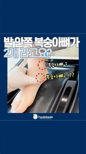 관리 가능한 부주상골 통증 (맞춤깔창 설계 이렇게!)
