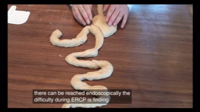 毕2式切除术 billroth 2 anatomy