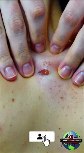 The SECRET to Removing Blackheads from Your Back is Here!