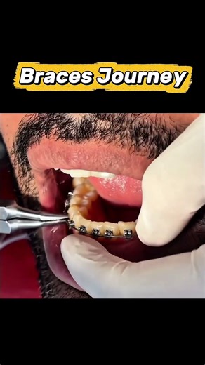 Getting braces tightened! 😫✨ The love/hate relationship! #braces #smile #asmr