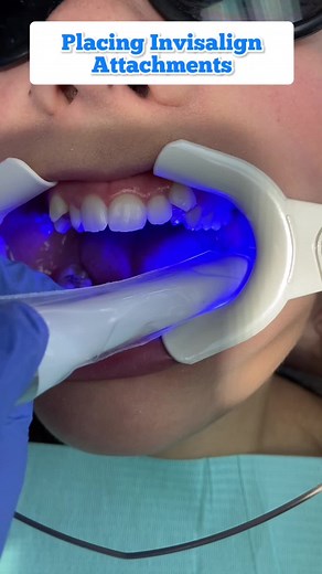Understanding Invisalign Attachments: A Comprehensive Guide