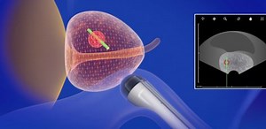 Prostate fusion biopsy –