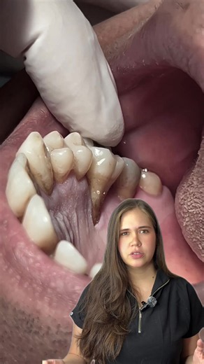 Mira este caso!! Debes cuidar muy bien tu higiene y realizarte limpiezas profesionales periodicas para evitar enfermedades periodontales 🫣 no digas que no te avisamos !! #limpiezadental #higienebucal #dientes #dentist #paratiii