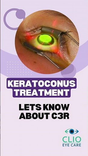 C3R treatment for keratoconus|Step by step |Clio Eye Care