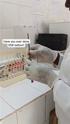 Have you ever seen ESR / VS on your lab test form and wondered what it means? #Lab #diagnosticlabs