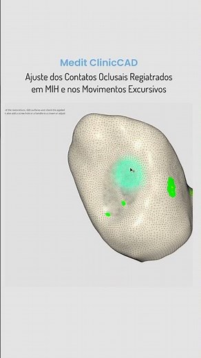 Mais uma ferramenta incrível do Medit ClinicCAD (app do Medit Link). A possibilidade de ajustar os c