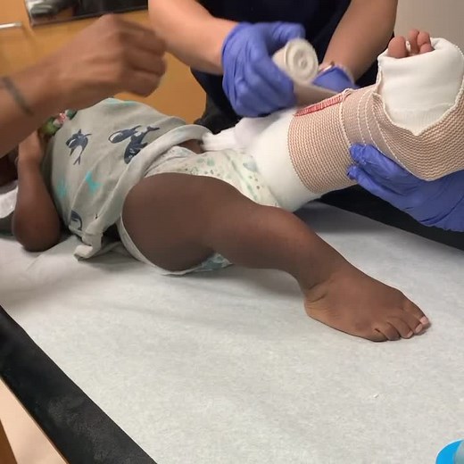 The DarkSide Of Brittle Bone Disease 🥺🥺 #BrokenLeg #fyp #doctors #Hospital