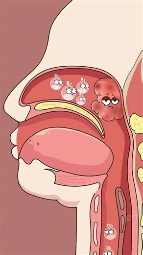 Health | Animation | Body | on Instagram: "Is your child's breathing habit changing their face? Did you know that long-term mouth breathing can actually lead to something called Adenoid Facies? When a child’s nasal passage is blocked (often by enlarged adenoids), they are forced to breathe through their mouth. Follow @healthmanazer11 for moree #AdenoidFacies #ChildHealth #MouthBreathing"