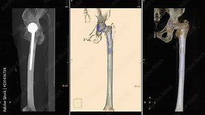CT SCAN image of pelvic bone / Hip bone 3D rendering image with Total Hip Implants / total hip replacement Rotating on monitor .