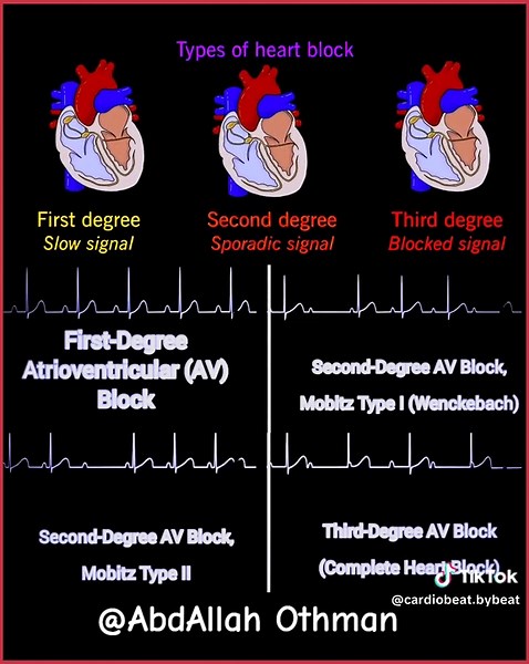 🎯📈 Atrioventricular (AV) Blocks: Save this guide 📌 | Share with your network! #Cardiology #ECG #HeartHealth #MedEd #AVBlocks