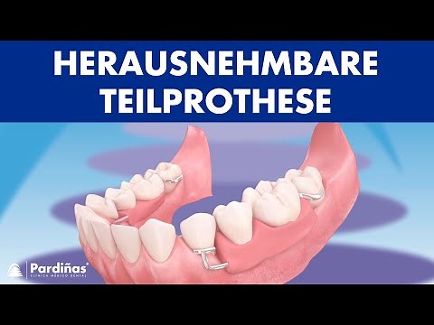 Herausnehmbare Teilprothese ©
