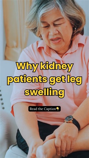 Swelling in feet or ankles isn’t normal — it’s a sign of fluid overload. ✔️ Kidneys can’t remove excess water ✔️ Sodium & fluid retention = puffiness ✔️ Can also be linked to heart strain ✅ Tips: Limit salt Elevate legs while resting Follow doctor’s fluid advice 💧 Swelling is your kidney’s SOS — don’t ignore it. 📘 Learn how to manage swelling naturally 👉 [Link in BIO] Follow for more updates. #kidneypatient #kidneydisease #kidneydiseaseawareness #usareels | The Kidney Disease Solution