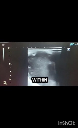 Ultrasound breast showing abscess! breast scan showing breast abscess! #ultrasoundmadeeasy86