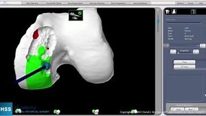 Unicompartmental Knee Arthroplasty with a Navigation System: Joint Reconstruction with Tibial Implant