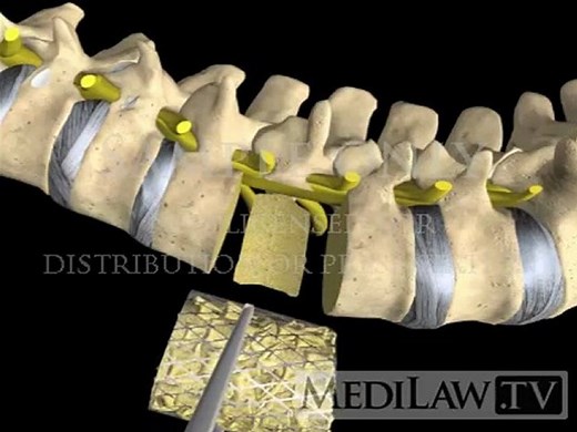 Lumbar Spine Surgery Vertebrectomy Corpectomy with cage orthopedic patient education