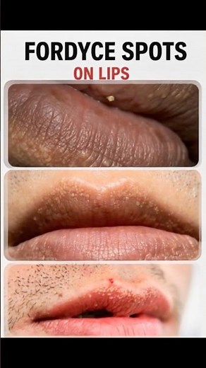 White spot on lips/Fordyce spots Free advice by MBBS MD(pysician) 📩anubhawsaswat@gmail.com