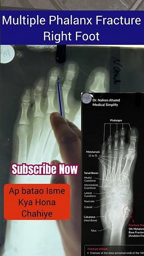 Foot X-Ray Anatomy & Multiple Phalanx Fracture Explained | Medical Simplify |Dr.Nafees Ahmad