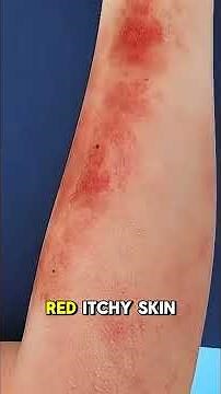 Chickenpox Explained | 3D Animated Medical Video (Short & Simple)