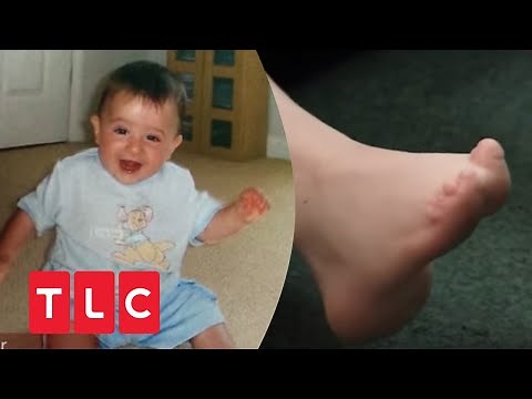 Leben mit dem Adams-Oliver-Syndrom | Body Bizarre | TLC Deutschland
