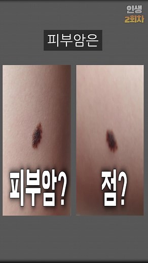 피부암의 증상과 예방법 | 흑색종 주의사항과 확인 방법