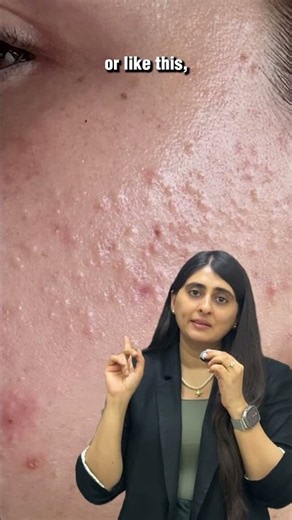 Salicylic acid for bumpy skin, whiteheads and blackheads