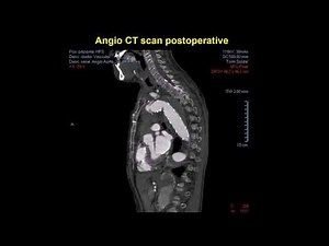 Frozen Elephant Trunk in Acute Type A in Aortic Dissection