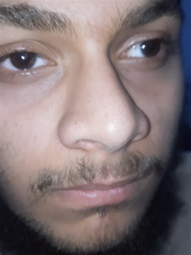 Understanding Nystagmus: Causes and Effects