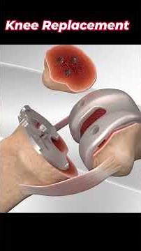 Knee replacement step by step #shorts #surgery