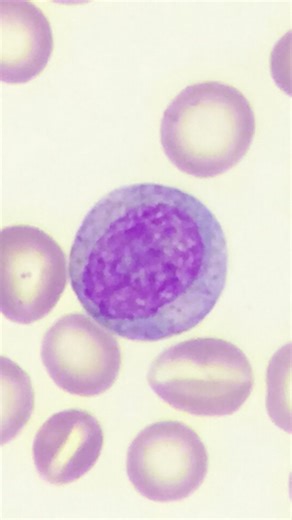 Daily CRISPR Updates on Instagram: "A new virus-like particle-based toolkit has been designed for efficient genetic engineering of human myeloid cells, facilitating CRISPR genome editing, enabling gene knockout, base editing, and epigenetic silencing while maintaining cell viability. The authors used this technology to perform screens in macrophages and identified TNFAIP3 as a key regulator of inflammatory responses. Notably, When TNFAIP3 was removed, the cells entered a pro-inflammatory state t