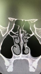 Reviewing CT scan of the nose, turbinates, septum