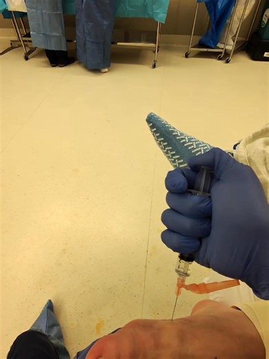 The Mayo block is an effective regional anesthesia technique for hallux and first metatarsal phalangeal joint (big toe joint) surgeries, involving a ring-like infiltration of anesthetic around the base of the first (long bone) metatarsal. It provides targeted pain relief, requires less local anesthetic than direct infiltration, and does not distort tissue planes. | North Texas Foot and Ankle Specialists, P.C.