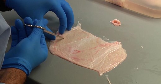 In what is being called a major step forward in medical technology, scientists are using a protein substance taken from a pig’s bladder to create a scaffold for new muscle to grow in patients with serious injuries