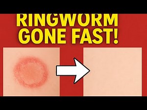 How to get rid of ringworm fast/natural home remedies that work.