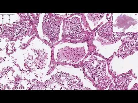 Histopathology - Bronchopneumonia