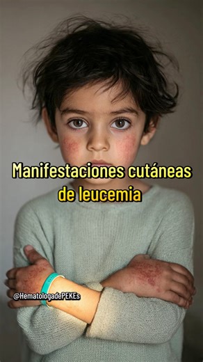 La leucemia cutis es una manifestación poco frecuente pero significativa: las células leucémicas infiltran la piel y producen lesiones visibles como nódulos, placas o manchas violáceas. Reconocer estos signos es fundamental para un diagnóstico temprano y un mejor manejo clínico. En este video te lo explico de manera sencilla y en menos de un minuto #leucemia #leucemiainfantil #leucemiacutis #Piel #hematologa | HematologadePekes