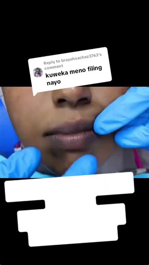 Replying to @brayohsachez3763 Front tooth broken Tooth repair at ksh 2000 for a single tooth. #foryoupage #sabela #goviral #cavityfillings #teeth