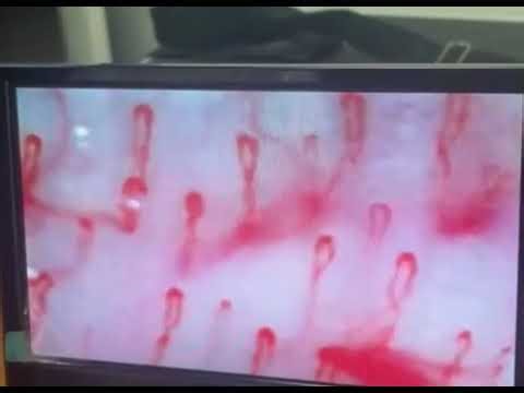 Capillary blood flow