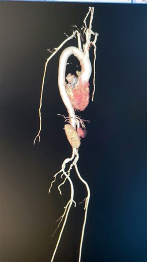 CT Abdomen angiography