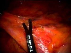 Laparoscopic Right Colectomy • Video • MEDtube.net