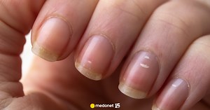 Skąd się biorą białe plamki na paznokciach. Siedem najczęstszych przyczyn