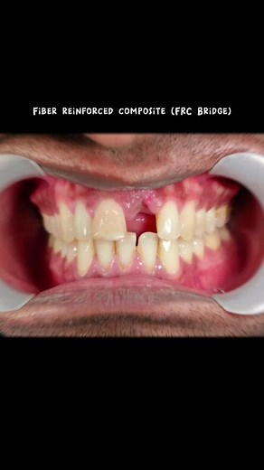Fiber reinforced composite (FRC Bridge) FRC ni salah satu rawatan utk gantikan gigi korang yang hilang tau! Kalau tak nak pakai gigi palsu (denture), boleh cuba buat rawatan